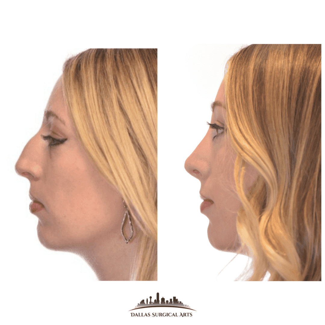 Dallas Rhinoplasty Cost Dallas Rhinoplasty Surgeon Dr Randy Sanovich Dallas Surgical Arts