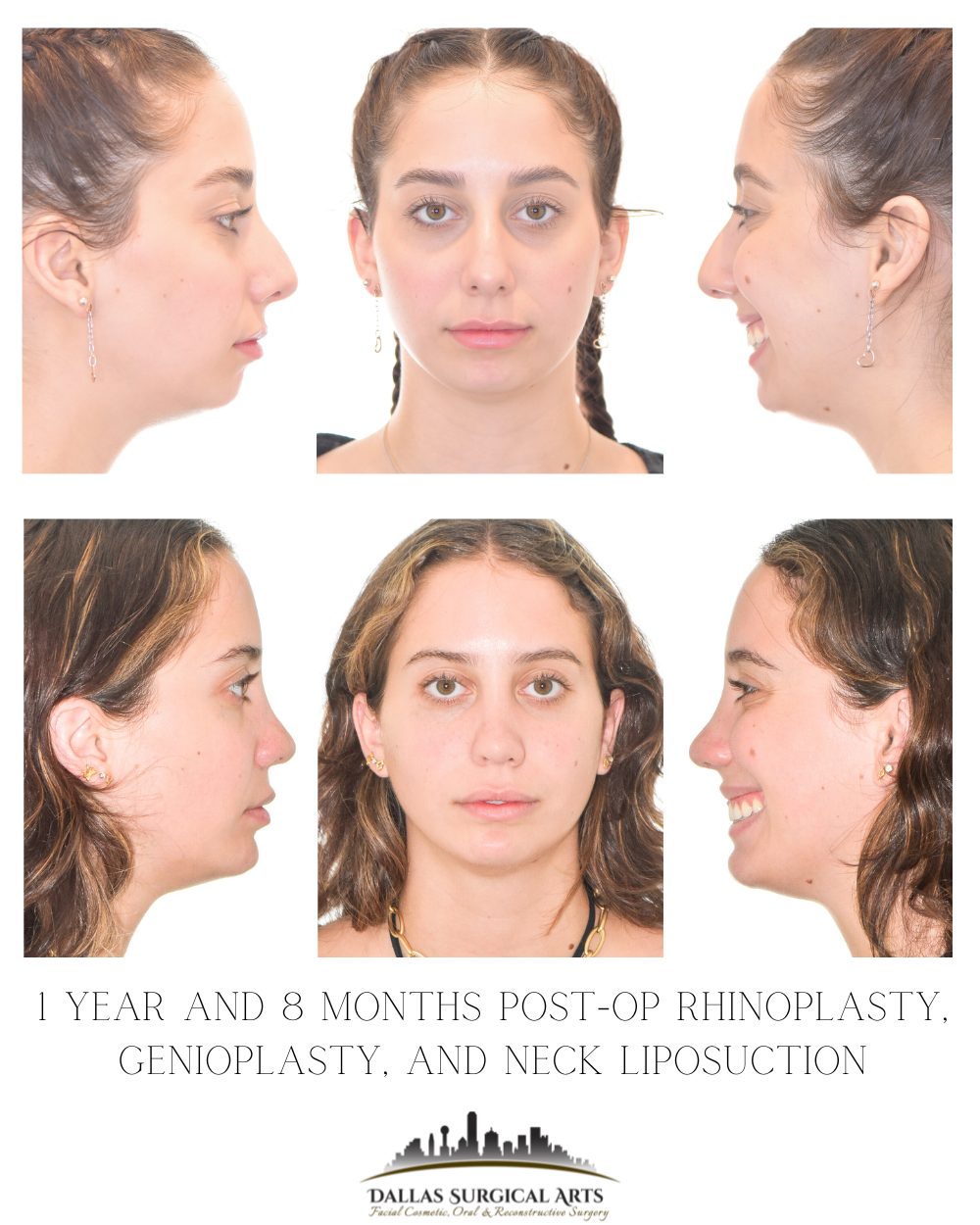 Dallas Rhinoplasty Cost Dallas Rhinoplasty Surgeon Dr Randy Sanovich Dallas Surgical Arts