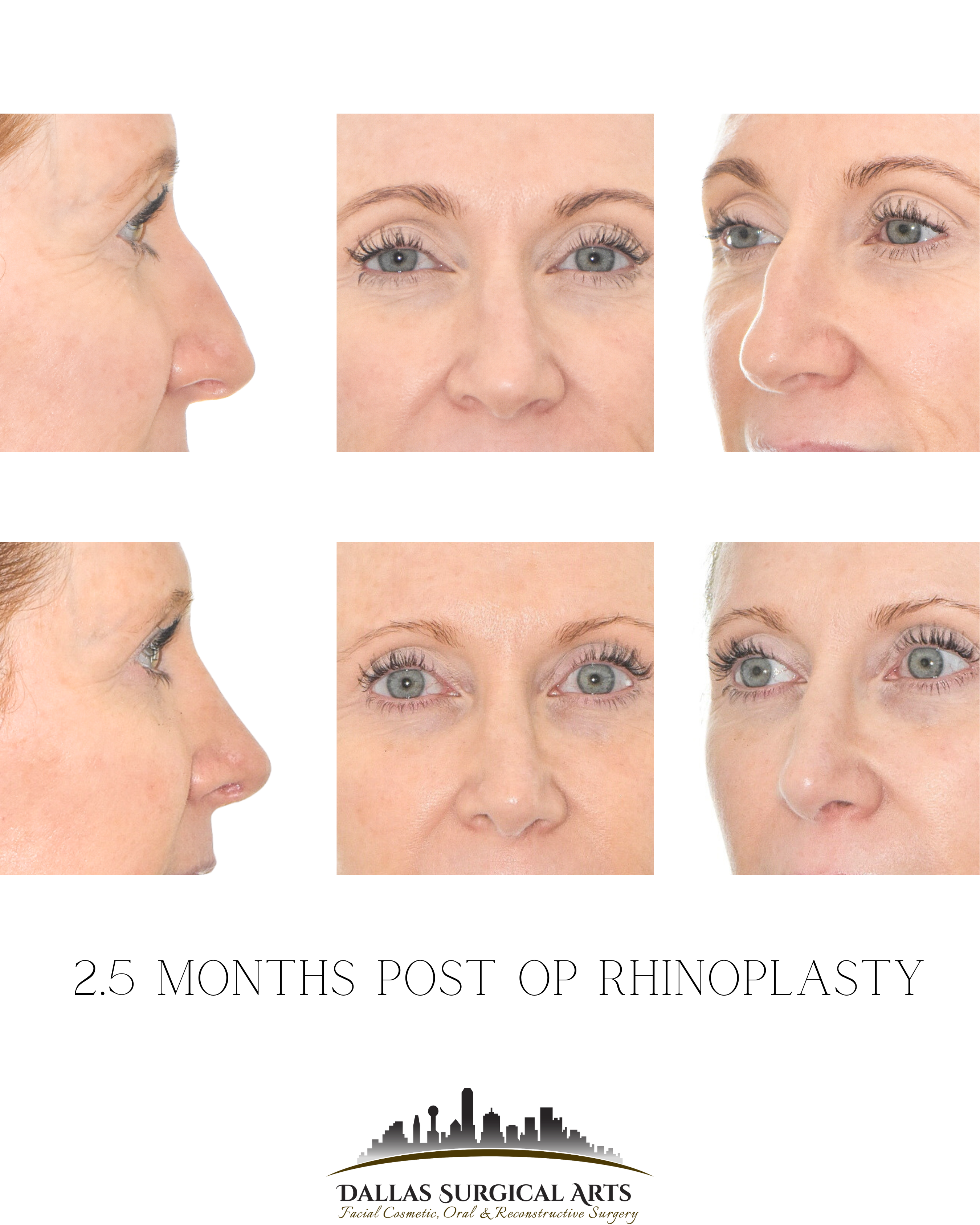 Dallas Rhinoplasty Cost Dallas Rhinoplasty Surgeon Dr Randy Sanovich Dallas Surgical Arts