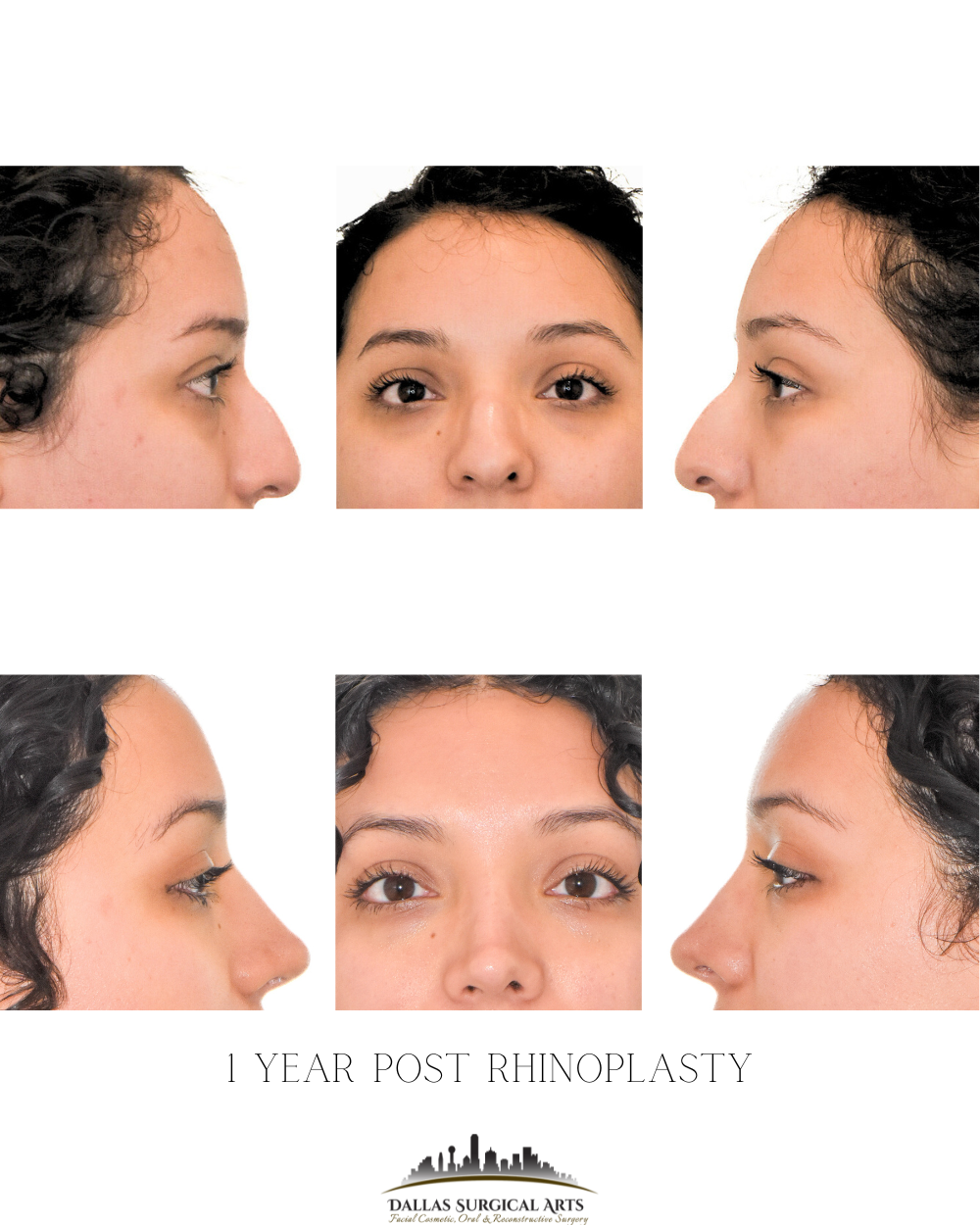 Dallas Rhinoplasty Cost Dallas Rhinoplasty Surgeon Dr Randy Sanovich Dallas Surgical Arts