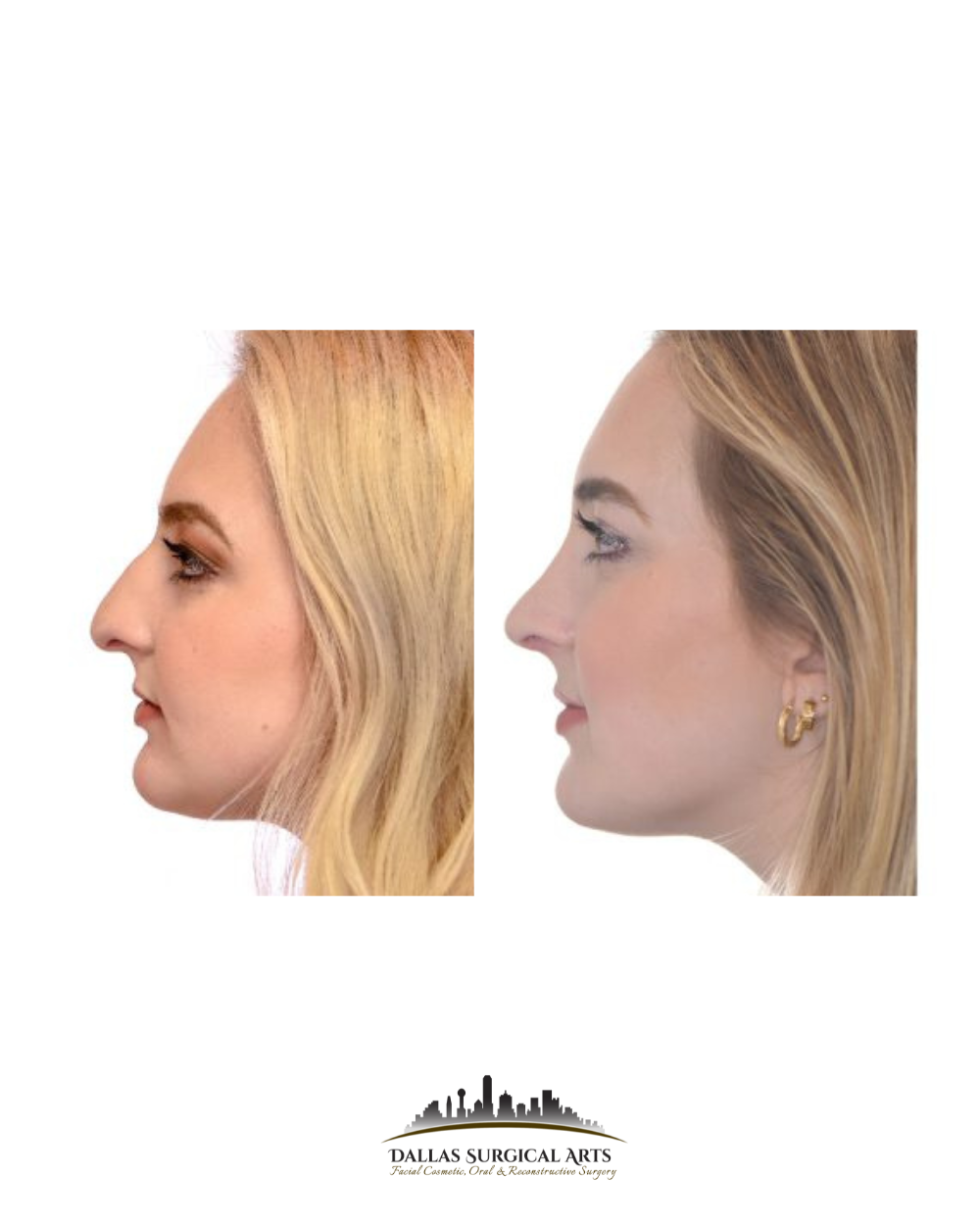 Dallas Rhinoplasty Cost Dallas Rhinoplasty Surgeon Dr Randy Sanovich Dallas Surgical Arts